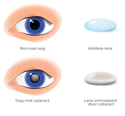Cyclopen specificatie kooi Cataract | Oogartsen Leuven